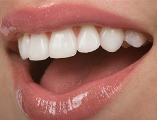 Porcelain Veneers—A Beautiful Alternative
