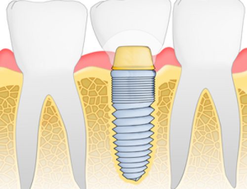 Implants—The New and Improved Tooth Fairy