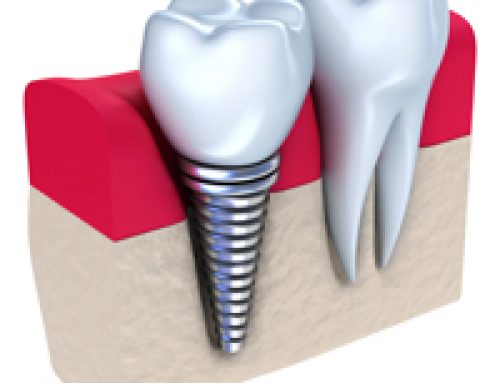 Dental Implants: Am I a Candidate?