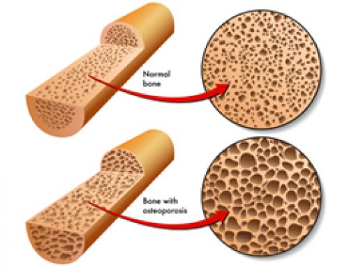 Osteoporosis: The Calcium Connection