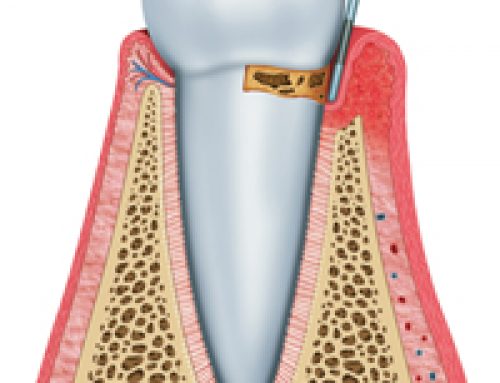 Periodontal Disease: It’s More Than Just Sore Gums