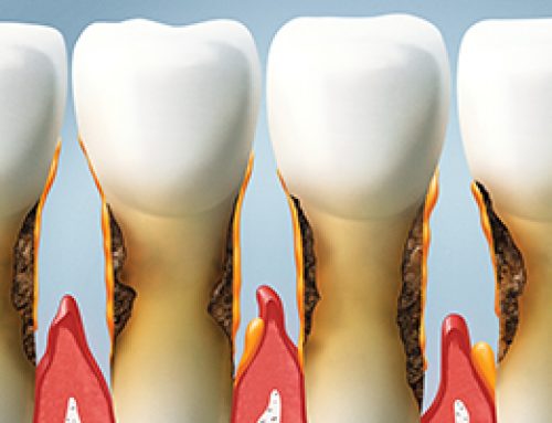 Root Surface Caries