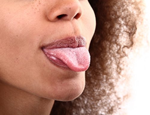 Tongue-Thrusting