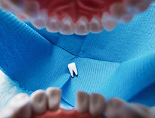 Have You Knocked Out a Tooth?
