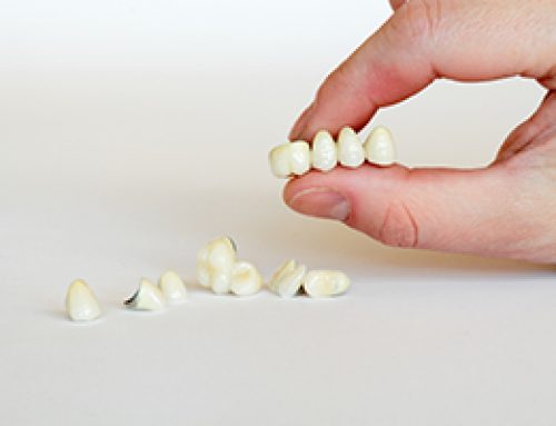 Crown and Bridge Treatment