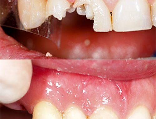 Changing Smiles by Bonding